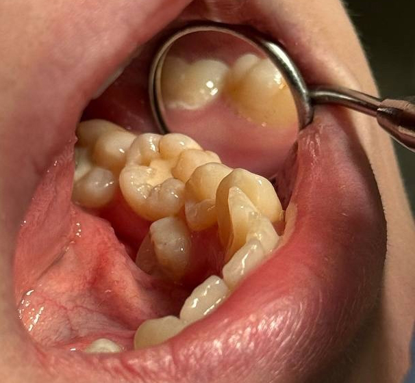 Зуб 3.6. Замена старой пломбы, функциональное восстановление. В одно посещение. Фото кейса ДО