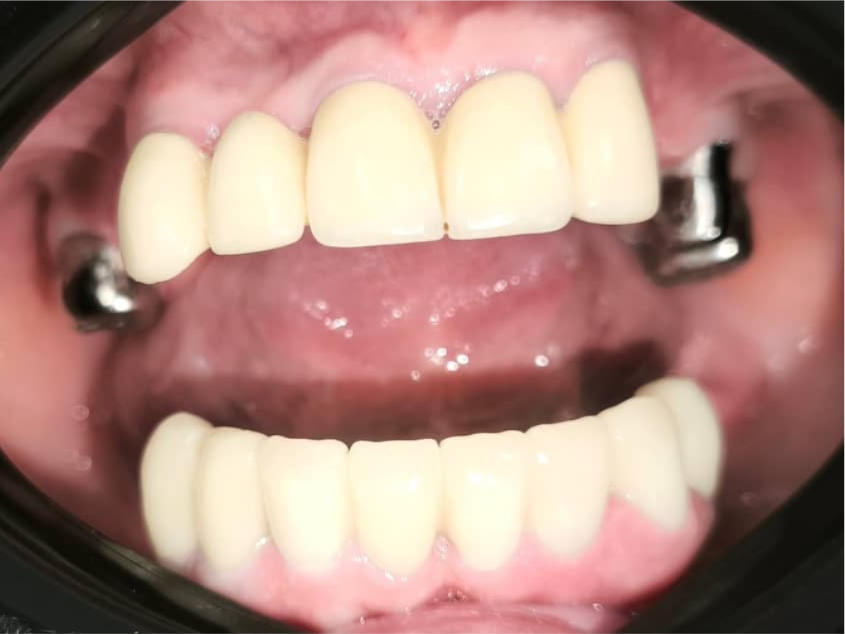All-on-6 на верхней челюсти: импланты Dentium, балочный протез за 2 приезда. Фото кейса ДО
