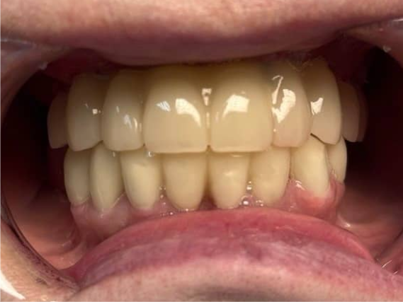 All-on-6 на верхней челюсти: импланты Dentium, балочный протез за 2 приезда. Фото кейса ПОСЛЕ