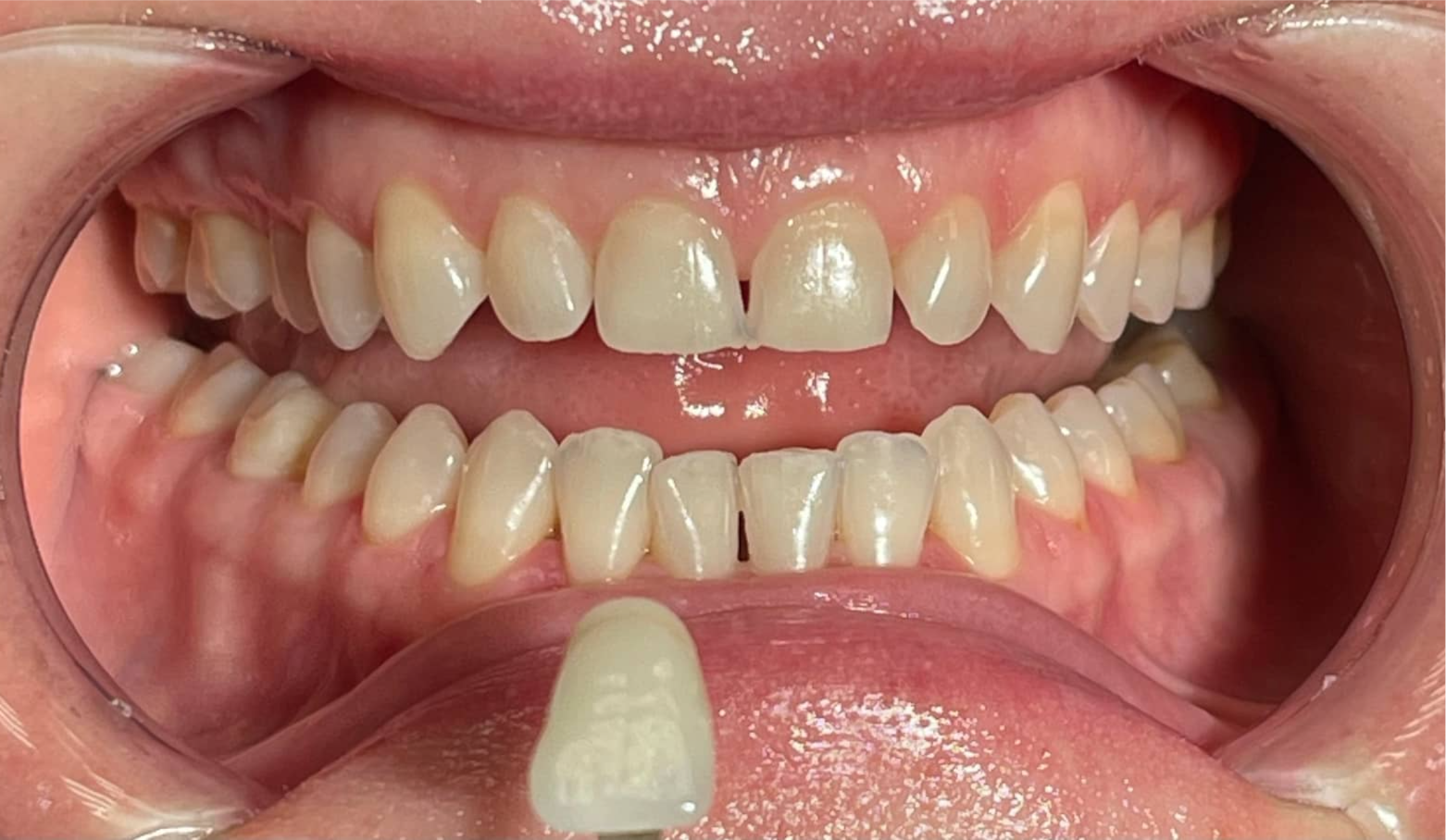 Отбеливание зубов системой Amazing White — до процедуры