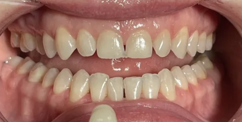 Кейс ДО профессионального отбеливания зубов системой Amazing White