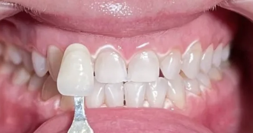 Кейс ПОСЛЕ профессионального отбеливания зубов системой Amazing White